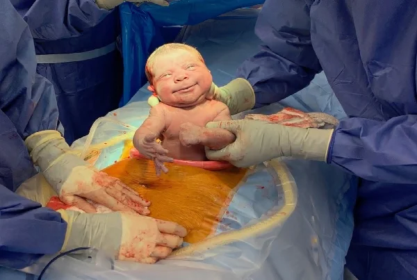 Caesarean Delivery